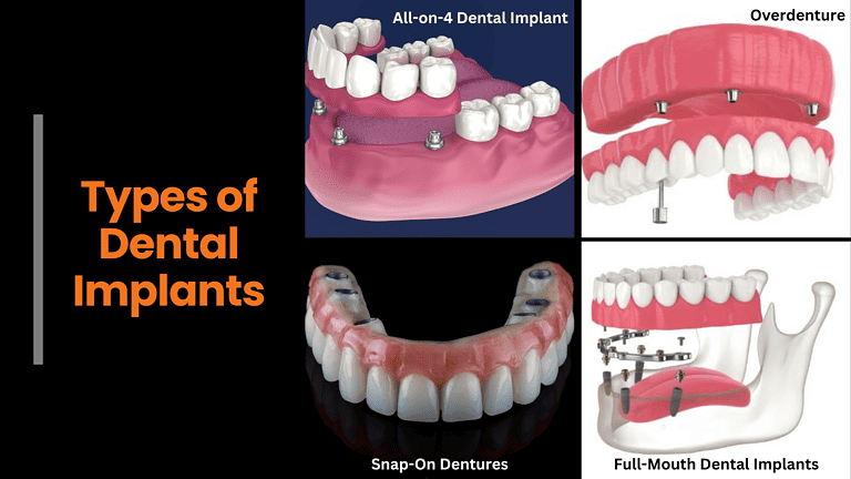 types-of-dental-implants