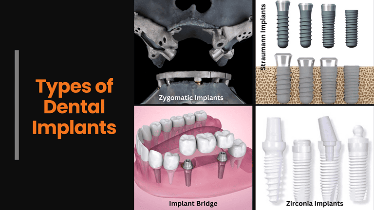 dental-implants-near-me