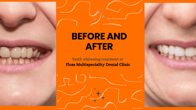 teeth-whitening-treatment-near-me